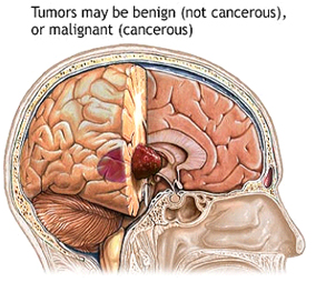 Brain Tumors Treatment India Offers info on Brain Tumors India, Brain India, Tumors India, Brain Problems India